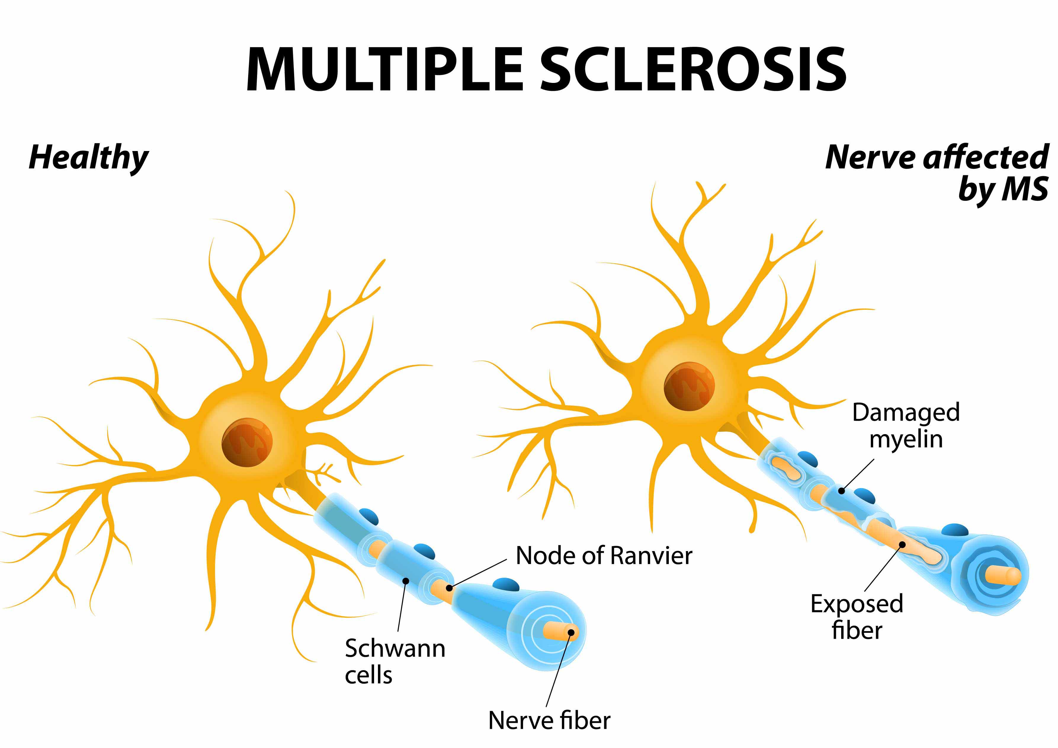MS Neuron Unterschiede