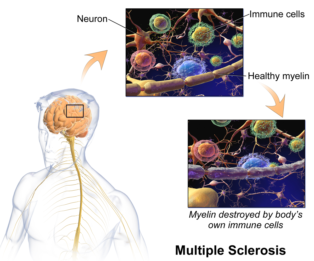 Das körpereigene Immunsystem zerstört bei MS die Myelinscheide