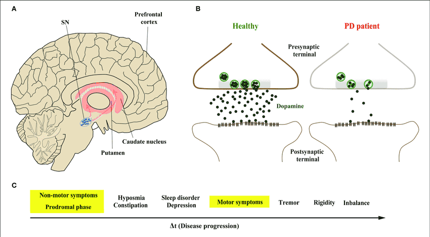 ANOVA-IRM-Deutschland-Parkinson-Krankheit-PD-dopaminerge-Neuronen-Stammzelltherapie