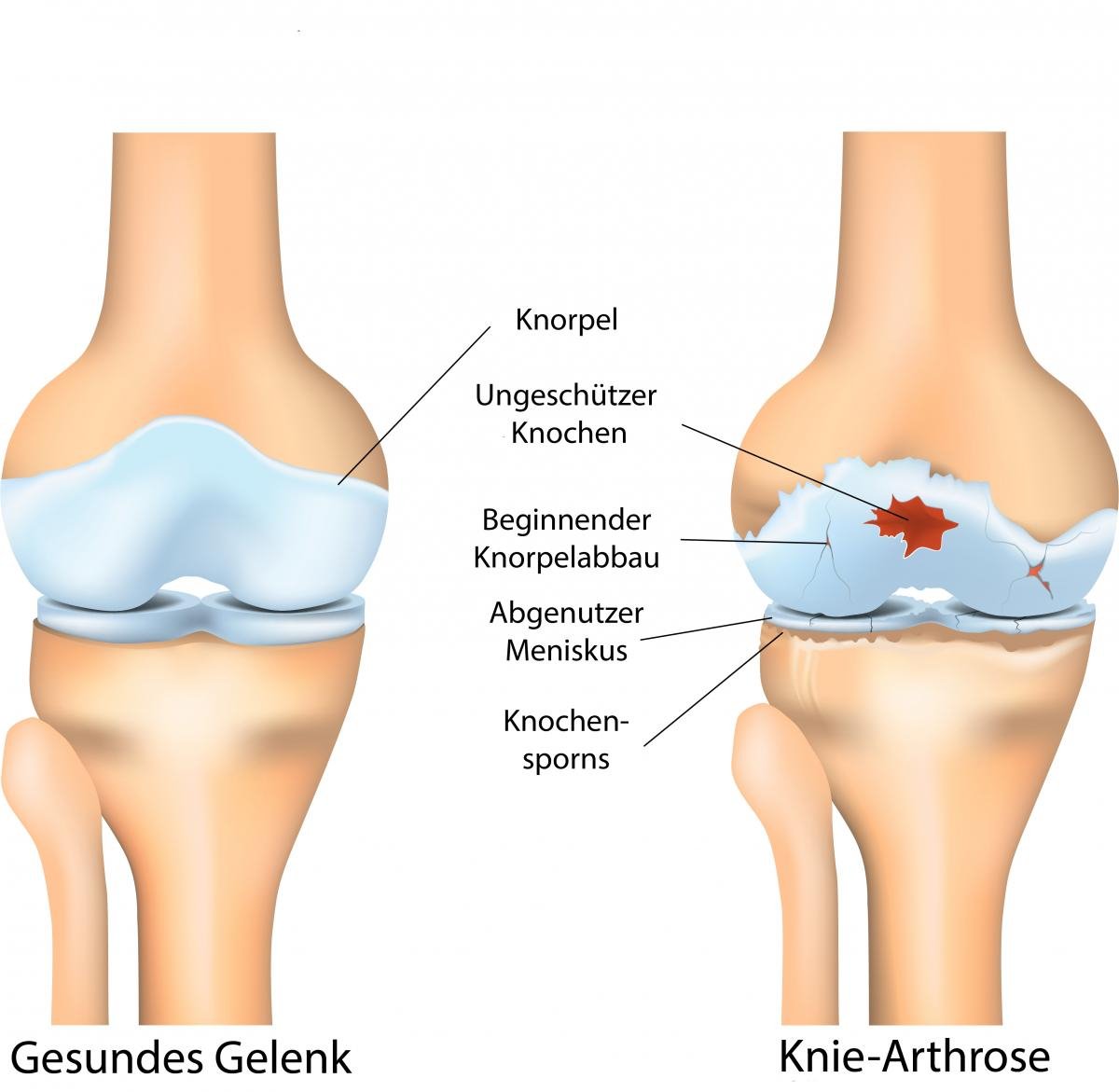Gelenkschäden bei Arthrose und Arthritis Gelenkschäden bei Arthrose und Arthritis | ANOVA IRM