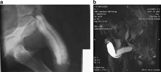 Erectile dysfunction ED diagnostics MRI Ultrasound US | Germany Erectile dysfunction ED diagnostics MRI Ultrasound US | Germany
