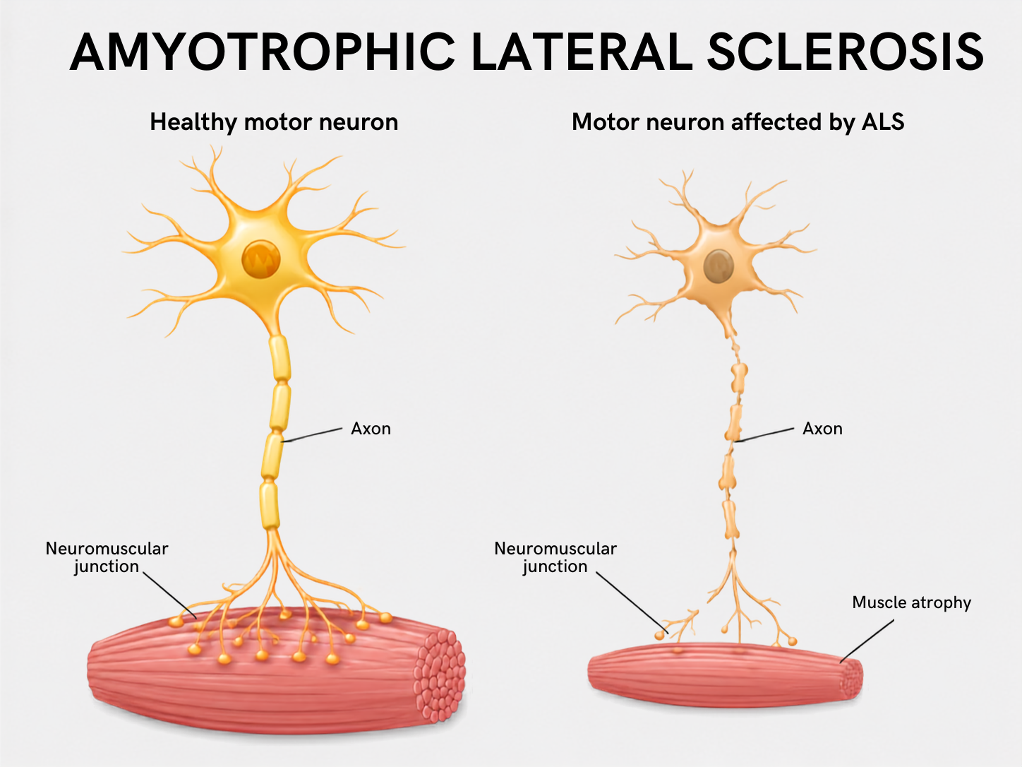 Healthy motor neuron compared with nerve cells affected by amyotrophic lateral sclerosis, also called Lou Gehrig's disease, showing reduced neuromuscular connections and muscle atrophy.