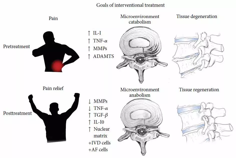 figure discogenic degenerative diseases