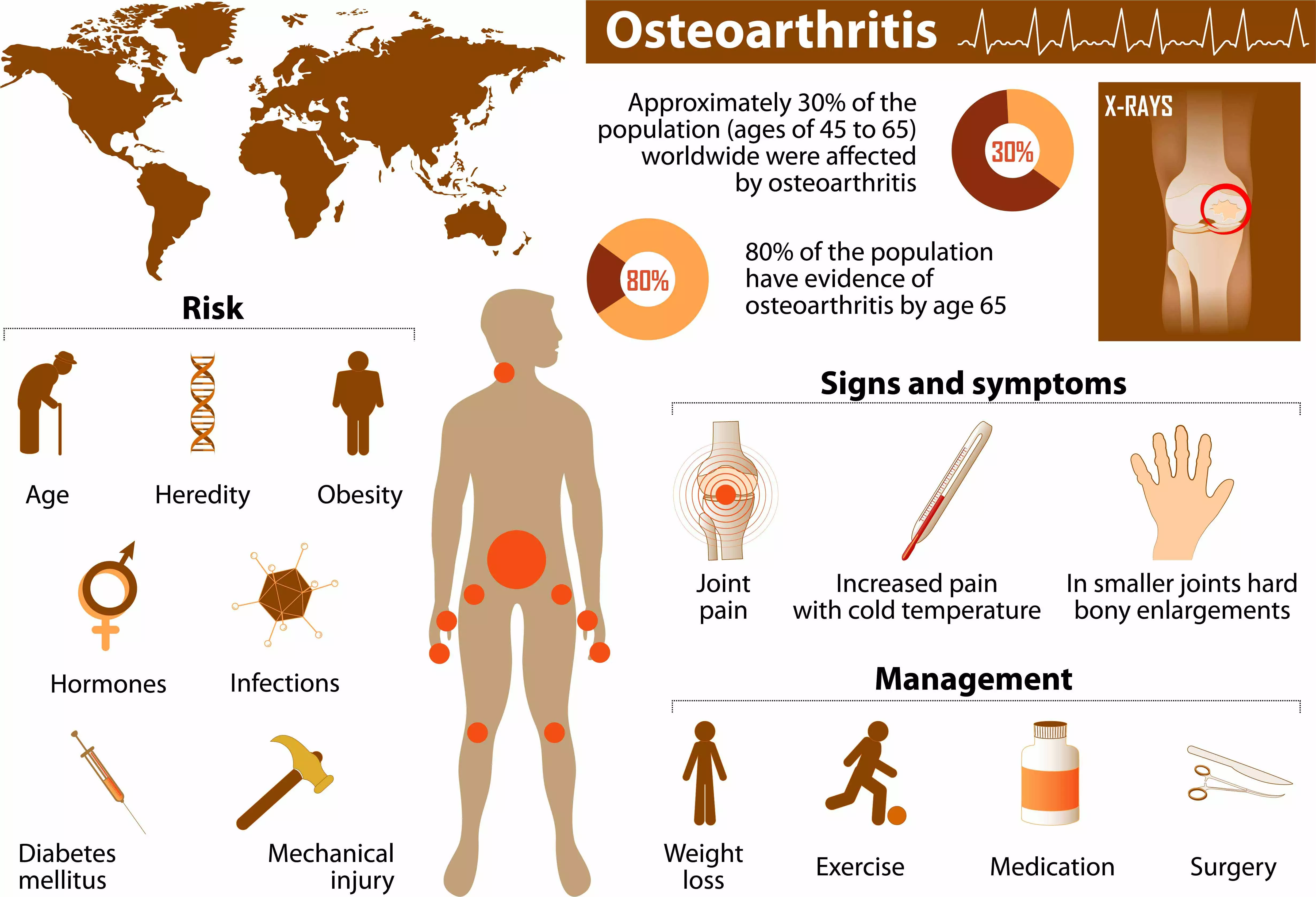 Osteoarthritis Statistic Osteoarthritis Statistic