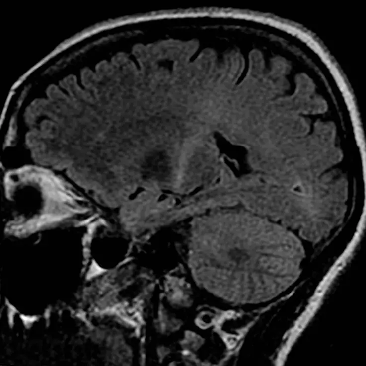 Gehirndegeneration bei ALS