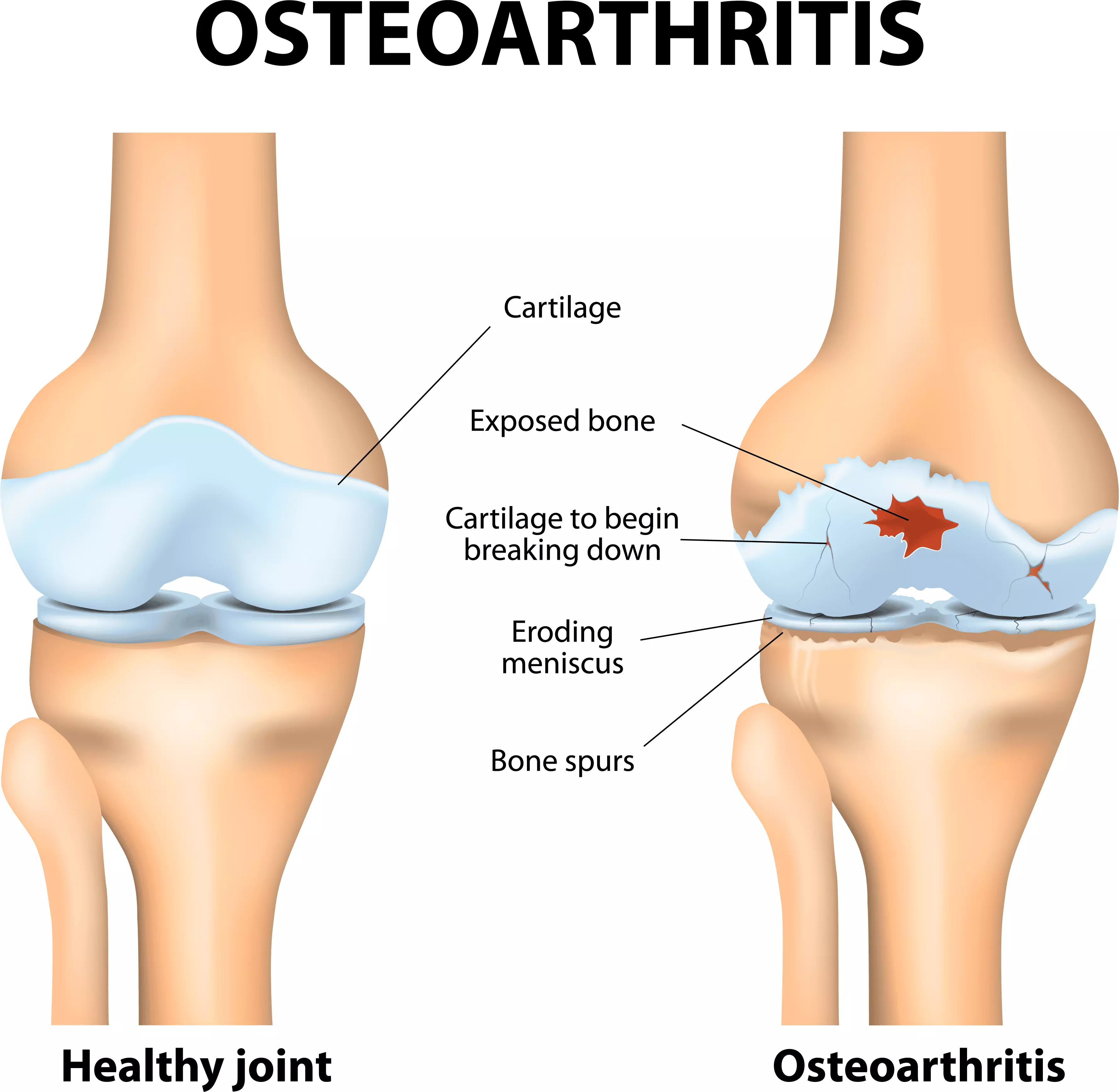 Joint and cartilage degeneration in OA Joint and cartilage degeneration in OA | ANOVA