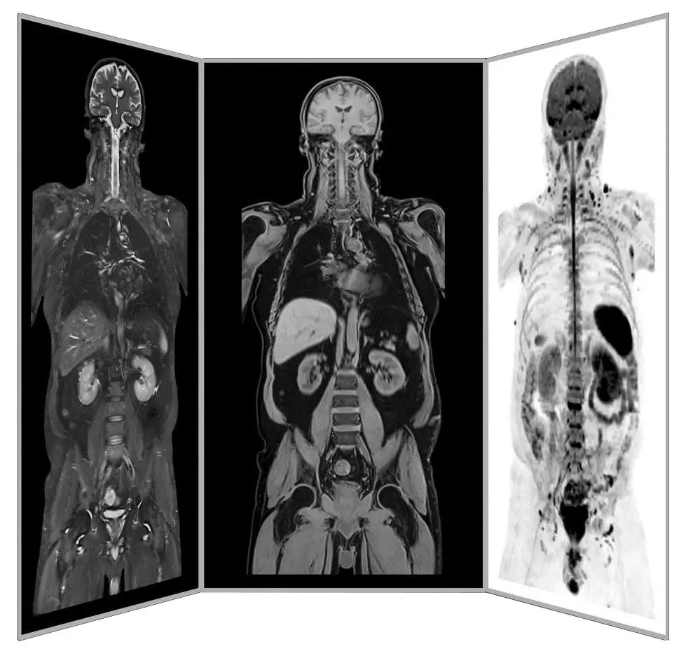 ANOVA IRM Deutschland Diagnostik MRT Schmerzen Ganzkörper Scan Siemens