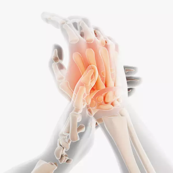 Rheumatoide Arthritis