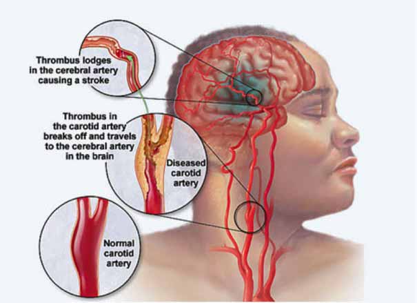 effects of stroke | ANOVA Germany effects of stroke | ANOVA Germany
